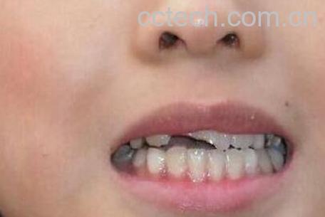 嘴上上火起泡怎么办-1