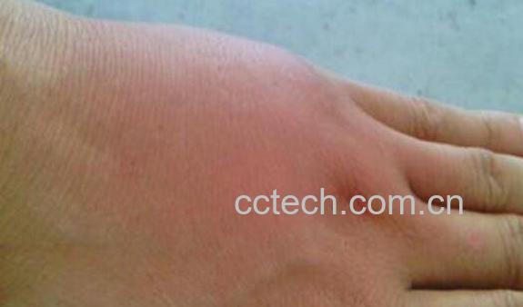 被蜜蜂蛰了怎么处理 被蜜蜂蛰了怎么消肿-0