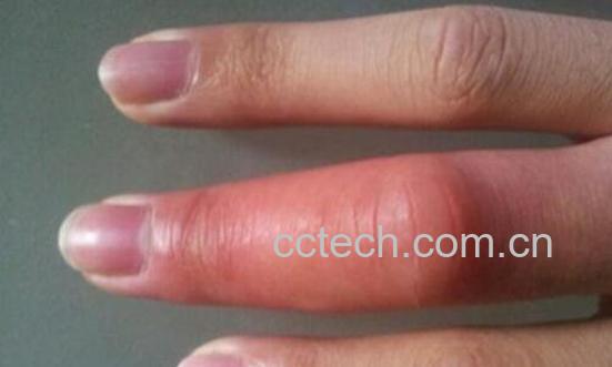 被蜜蜂蛰了怎么消肿快 蜜蜂蛰消肿的最快方法-0