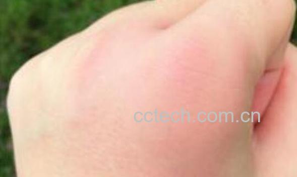 被蜜蜂蛰了怎么处理 被蜜蜂蛰了怎么消肿-1