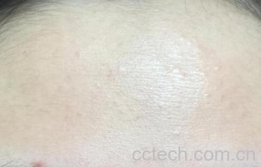 粉刺怎么消除 粉刺去除小妙招-1