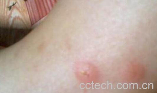 蚊子咬了怎么消肿止痒最快-1