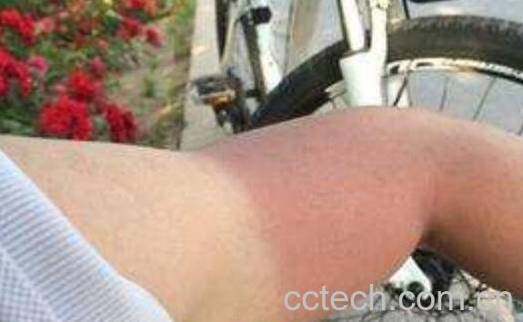 晒伤后怎么处理 晒伤后如何修复-0