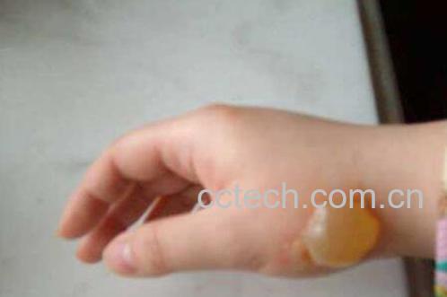 被油烫伤后怎么处理 油烫伤后的处理方法-0