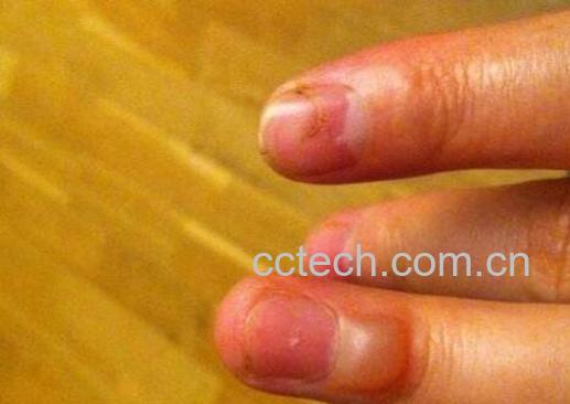 被油烫伤后怎么处理 油烫伤后的处理方法-1