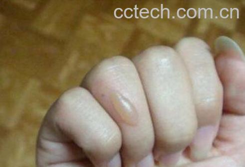 被油烫伤怎么办 被油溅到了皮肤小妙招-0