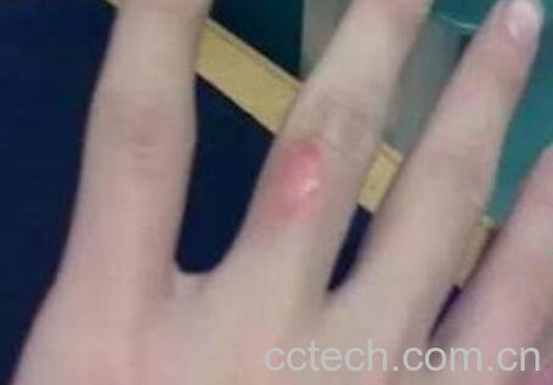 油烫伤起泡后怎么处理 被油烫伤怎么去疤-0