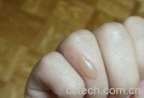 油烫伤起泡后怎么处理 被油烫伤怎么去疤-1