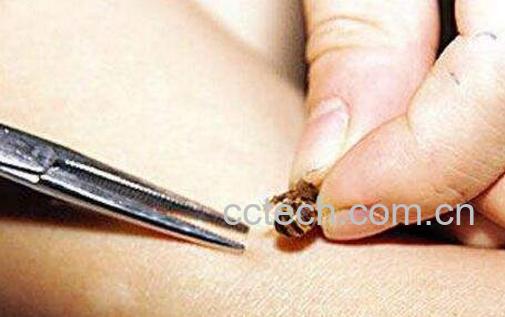 被蜂蜇了怎么办 被蜜蜂蛰了怎么处理-0