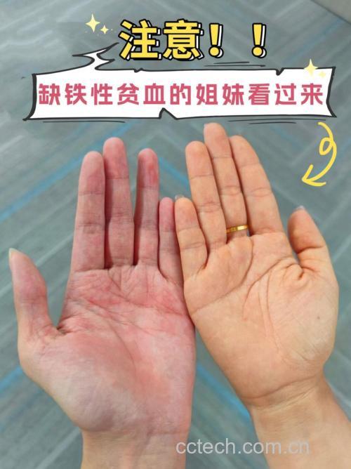 缺铁性贫血晚期会怎么样？