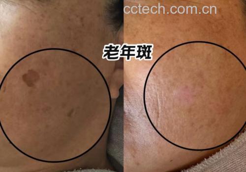 科研人员在黑龙江省中医药大学实验室操作共聚焦显微镜,屏幕实时显示80岁受试者使用椴树蜜7天后面部角质层图像:细胞轮廓清晰,细胞间脂质荧光强度提升41%,证明屏障功能强化 实验室场景:科研人员用共聚焦激光显微镜观测80岁受试者使用椴树蜜前后角质层结构变化,屏幕显示处理后角质细胞排列更致密,细胞间隙荧光标记明显减少