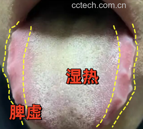 中医体质辨识对比图：左侧为脾胃虚寒体质典型舌象（舌体胖大、舌质淡白、边缘齿痕明显、苔白滑）；右侧为湿热体质舌象（舌质红、苔黄厚腻、舌尖芒刺）