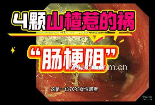 临床病理对照图:高清胃镜下胃窦黏膜充血区(箭头指向)与椴树蜜结晶样本并置,直观呈现‘食用不当’与‘组织损伤’的因果关系;图中胃镜影像经脱敏处理,符合医疗伦理规范 医生手持胃镜影像图与椴树蜜样品对比:左侧显示胃窦部轻度充血糜烂,右侧为标准椴树蜜结晶样本,中间用箭头标注“空腹食用→胃酸↑→黏膜损伤”病理通路